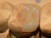 стоматология реставрация зубов
